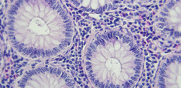DNA analysis shows colorectal cancer has unique microbial fingerprint