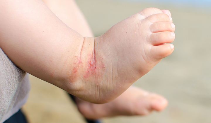 eczema on foot