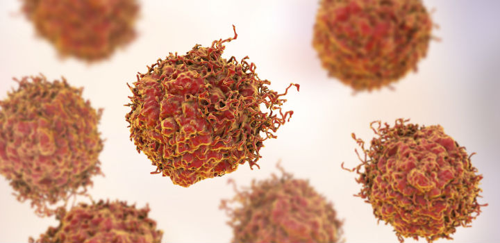 prostate cancer cells under a microscope